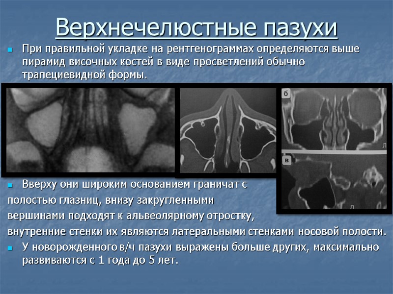 Верхнечелюстные пазухи При правильной укладке на рентгенограммах определяются выше пирамид височных костей в виде